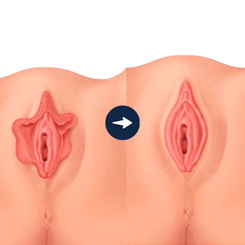 labioplastia