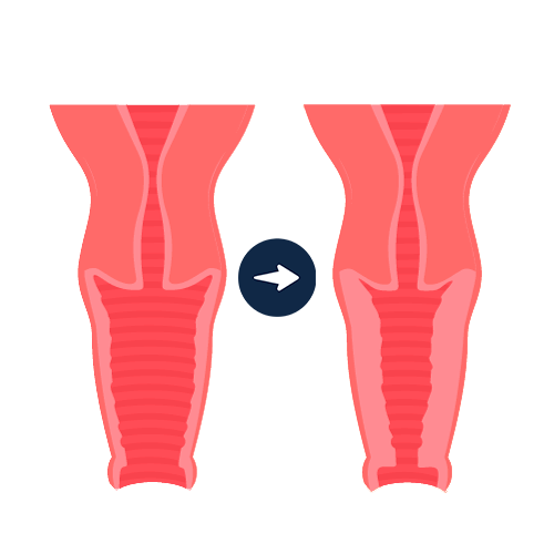 tensadovaginal  